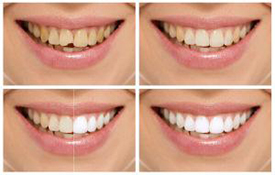Smile Makeover | Fuchs & Fuchs Dentistry | Elk City, OK Dentist