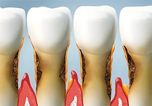 Gum Disease Treatment | Fuchs & Fuchs Dentistry | Elk City, OK Dentist