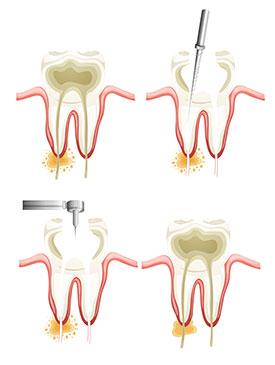 Endodontics | Fuchs & Fuchs Dentistry | Elk City, OK Dentist