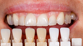 Porcelain Veneers | Fuchs & Fuchs Dentistry | Elk City, OK Dentist